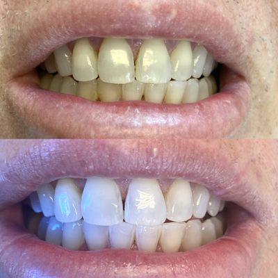 Laser Teeth Whitening