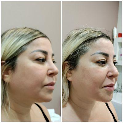 Non surgical 7D Ultra HIFU Lipo Plus cheek fat reduction