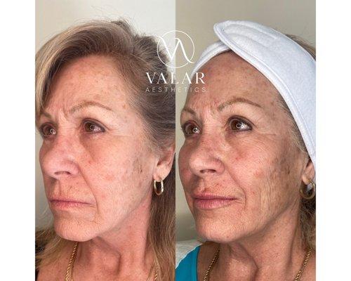 Before and afters of mid-face and lip Restylane filler