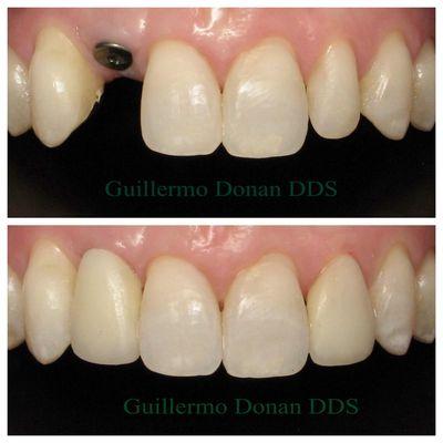 Restoring a beautiful Smile with Dental Implants and Veneers                              @ Guillermo Donan DDS   559 222 9923