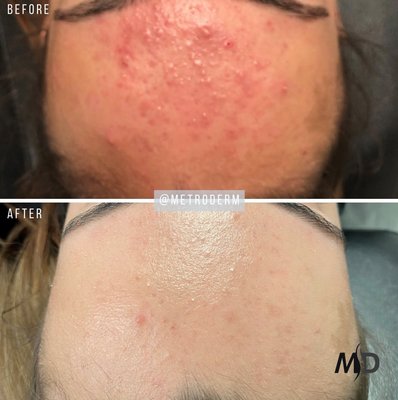 Acne treatment before and after results.