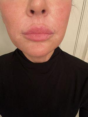 5 months post treatment with Matrix RF Microneedling, Ultraclear Erbium Laser and Juvederm Dermal Filler.