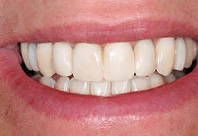 Creative Dental of Queens smile