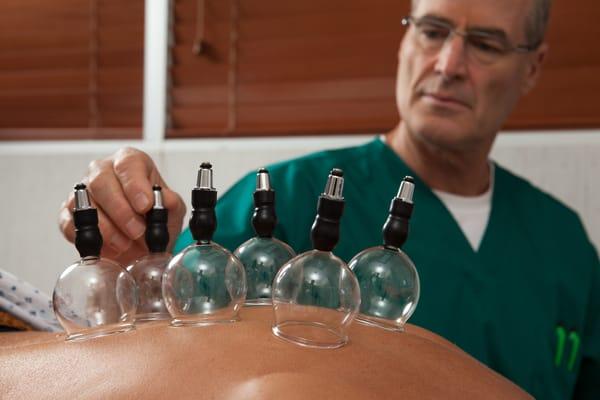 Dr. Chasens performs cupping on a patient