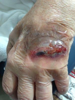 Injury to hand which should have been shown to a wound care specialist without our having to insist.  Sorry to be graphic.