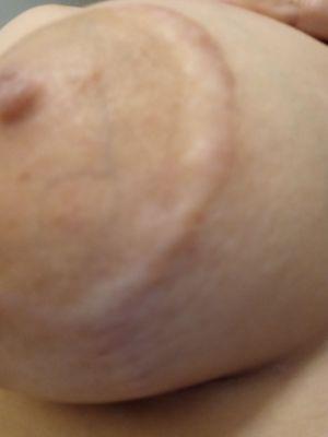 The scars i ended up with after Dr.Chen did a breastlift on me.