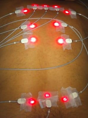 Acupuncture performed with cold lasers!