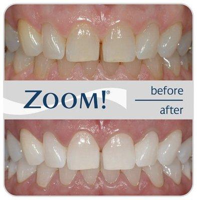 ZOOM! Whitening