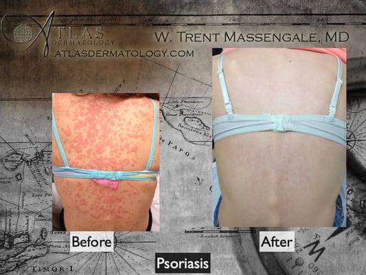 Psoriasis treatments