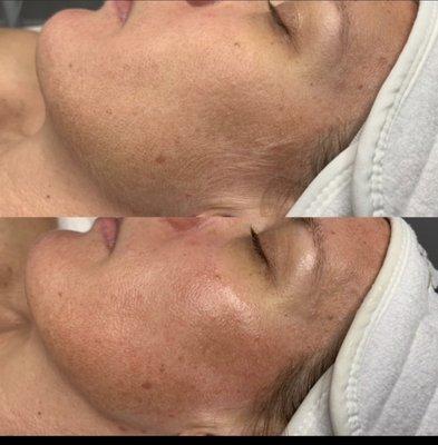 Dermaplaning before and after