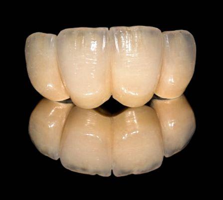 4 unit Zirconia Bridge