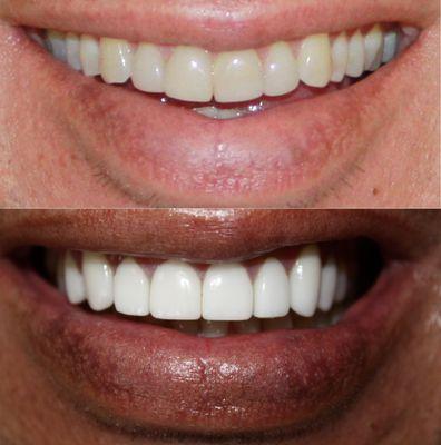 Lumineers can transform your smile (top) to any style you desire (bottom) with no shots. Call for a FREE Lumineer consultation.