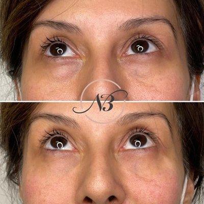 Under eye refresh using our Bella Eyes package by Nurse K