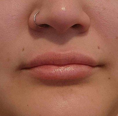 Lip filler