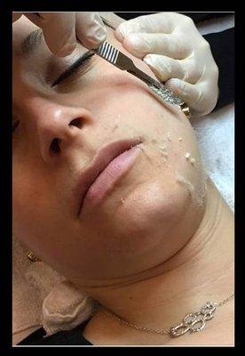 Dermaplaning - #1 requested Facial in USA!