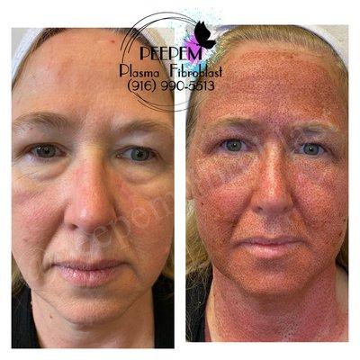 Full face and neck fibroblast treatment