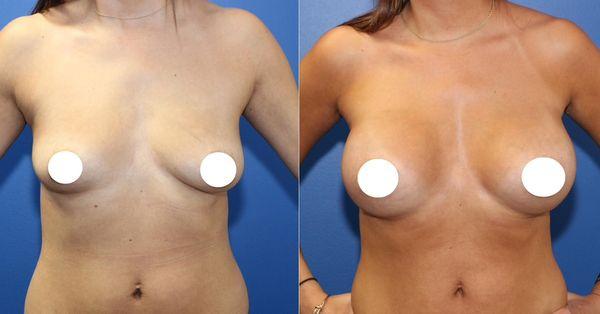 Breast augmentation before and after