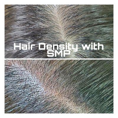 Hair Density Treatment with Scalp Micropigmentation 

This can also stimulate hair regrowth