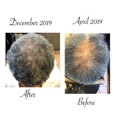 JRS Hair Restoration services before and after