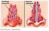 There is no reason to live with extra cartilage! Dr. Wayne can reshape your Septum to help you breath, sleep, improve your quality of life.