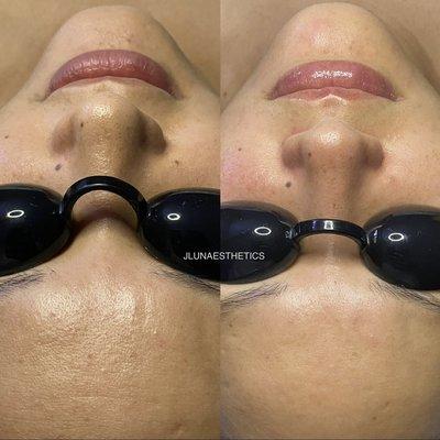 Hydro Facial