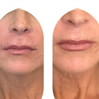 Before & Immediately after lip filler