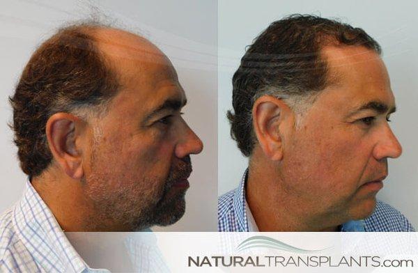 Hair Loss Centers Near Me