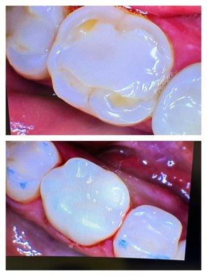 Broken down tooth and patient complain of pain.  Long term solution we placed a crown to restore her tooth.