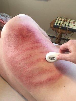 Gua Sha therapy.  Not painful the marks go away in about a week.