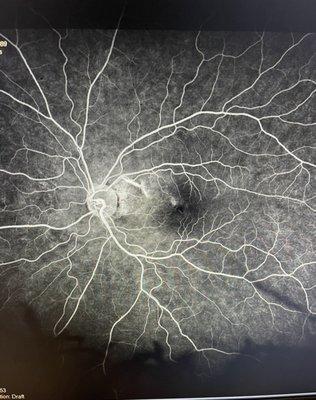 Macular Neuroretinopathy