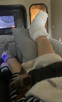 After surgery. Broken ankle in a large soft cast. Circulation device on other leg. Also, doggie on lap taking care of mama :)