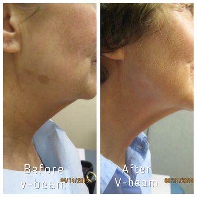 V-beam treatment to lessen appearance of brown spots