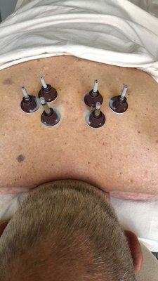 Moxibustion