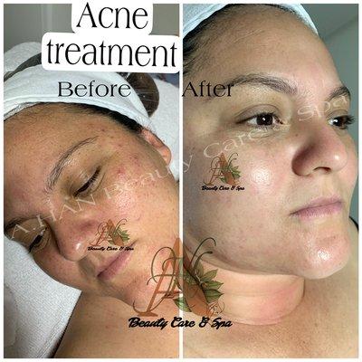 Acne treatment