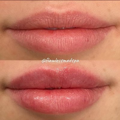 Check out this subtle natural lip enhancement by our nurse injector Amanda