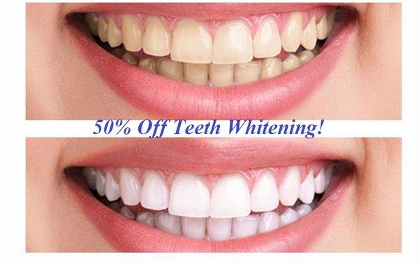 50% Off Teeth Whitening!
 www.texastotaldental.com