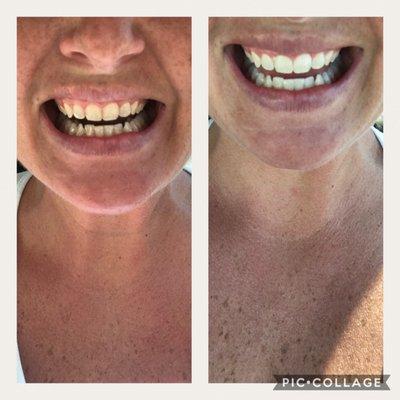 Atlantic Teeth Whitening