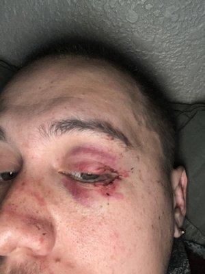 Black eye RECEIVED from ROCKLIN POLICE OFFICER