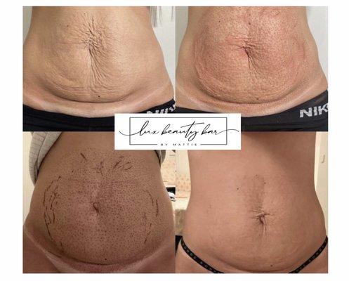 Plasma Pen and Stretch Mark Camouflage before and after