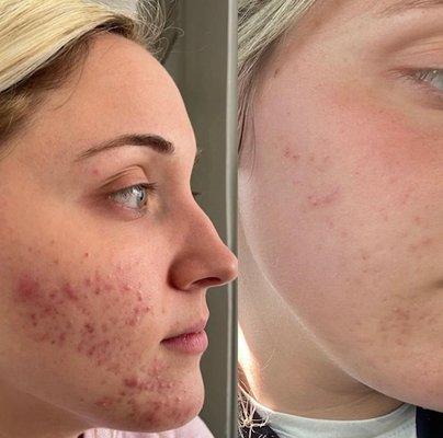 12 week acne transformation.