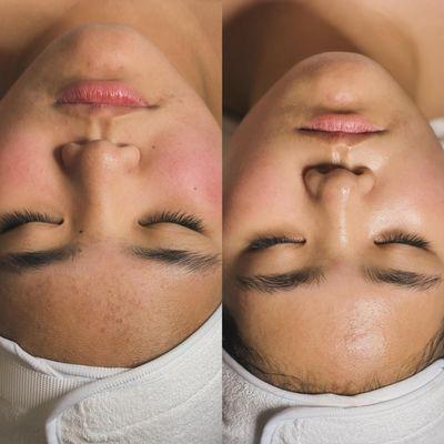 O'Melon Omega Facial Treatment Before and After Result. This treatment good for congested, acne-prone and sensitive skin.