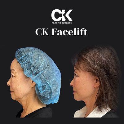 CK Plastic Surgery Facelift