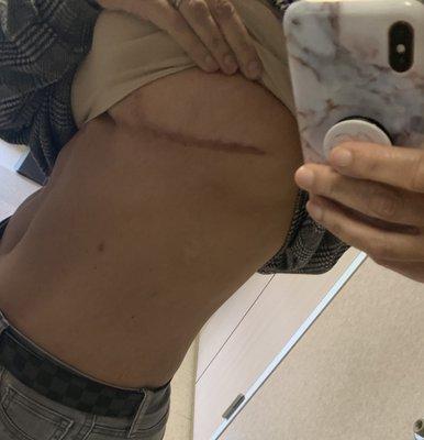 Barbaric breast lift scars 10 months after the procedure.