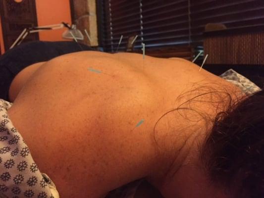 Acupuncture