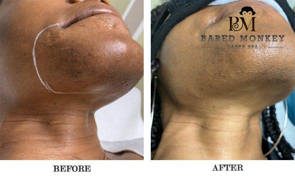 Smooth Skin with Laser Hair Removal