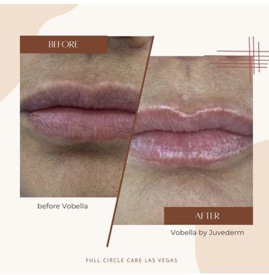 Before and after Vobella by Juvederm