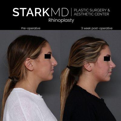 Rhinoplasty Philadelphia