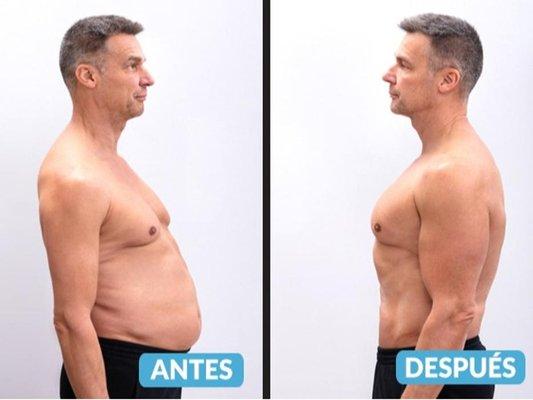 Med-Aesthetic Cosmetic Laser - hombre con antes y despues de tratamiento para descenso de peso