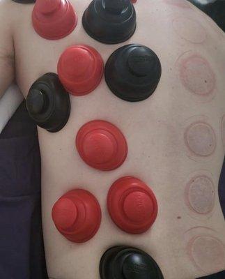 myofascial cupping using RockPods.