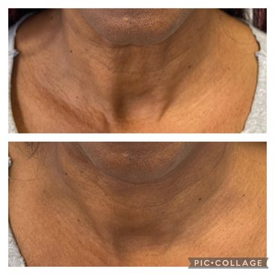 Lunch Time Neck Lift using PDO Threads